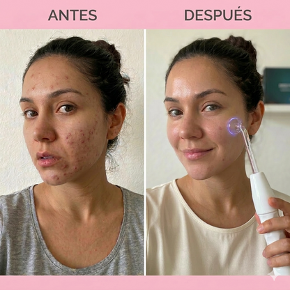 Dispositivo Facial y Capilar de Alta Frecuencia